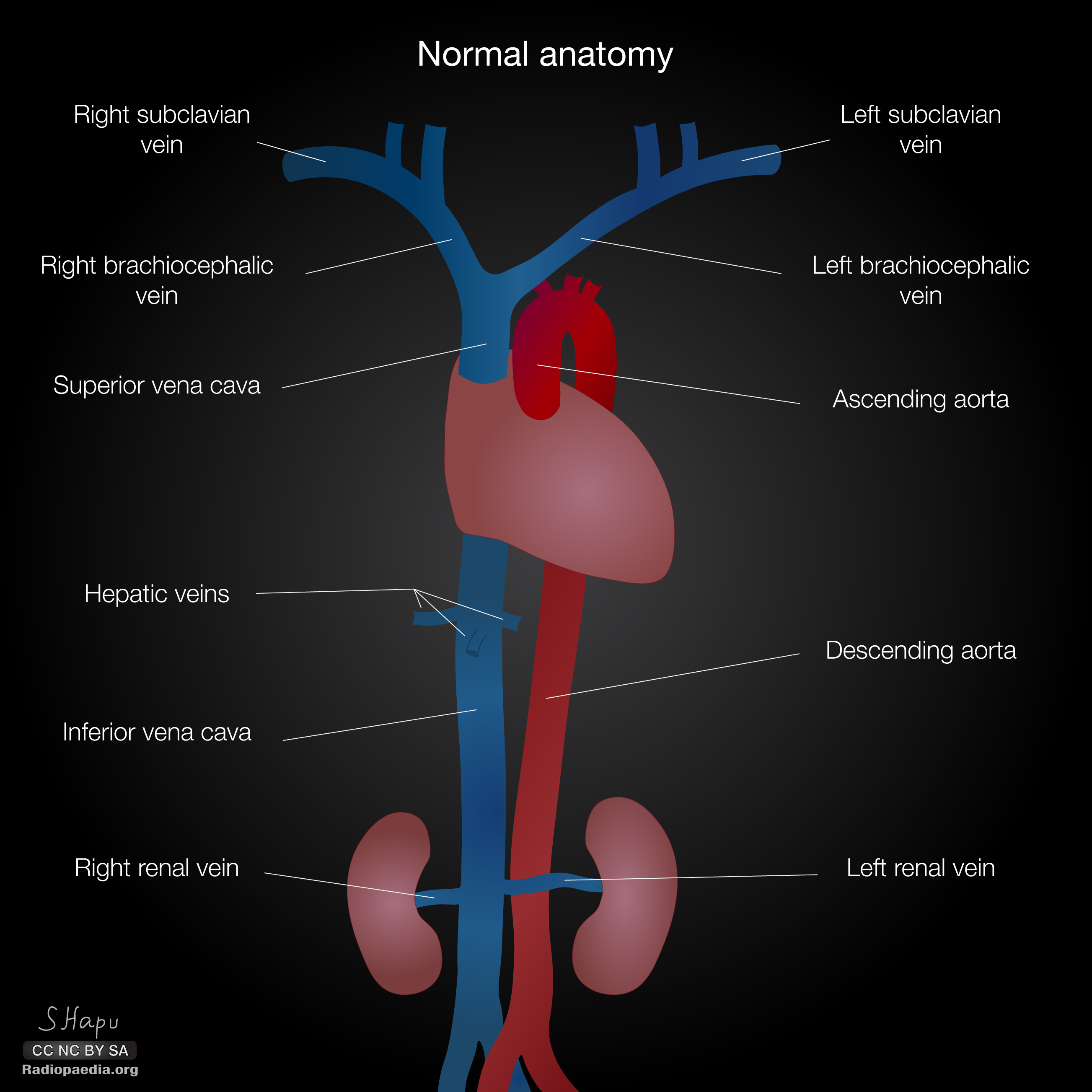 abdominal-aorta-arteries-and-veins-vena